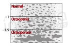 Evaluation de la densité osseuse en fonction du score de densité osseuse. Plus ce score est bas, plus les os sont poreux et donc fragilisés